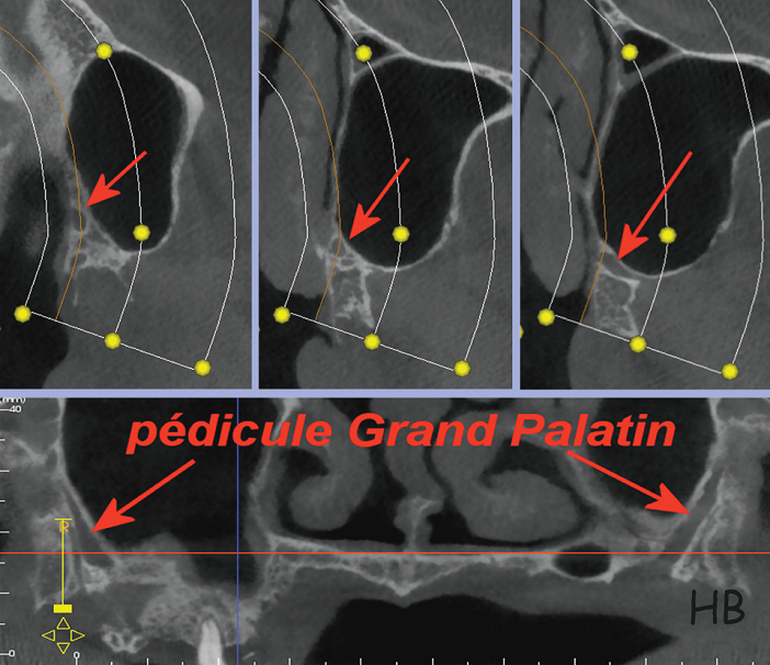 pedicule grand palatin