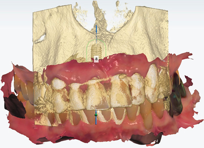 planification-d-un-implant-Straumann