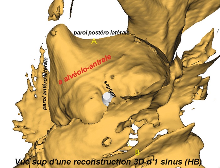 reconstruction 3D d-un Sinus