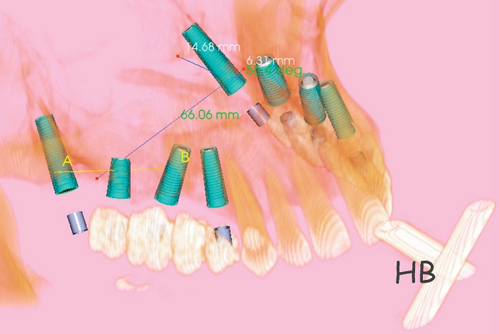 reconstruction 3D en vue d-une chirurgie guidee optimisant l-exploitation