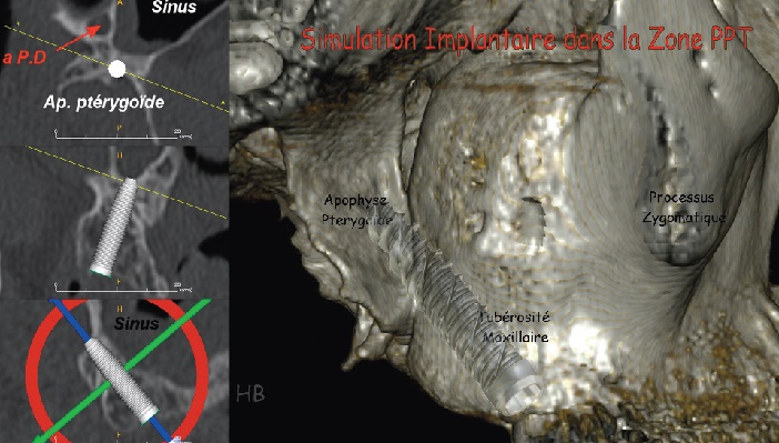 region Pterygo-Palato-Tuberositaire