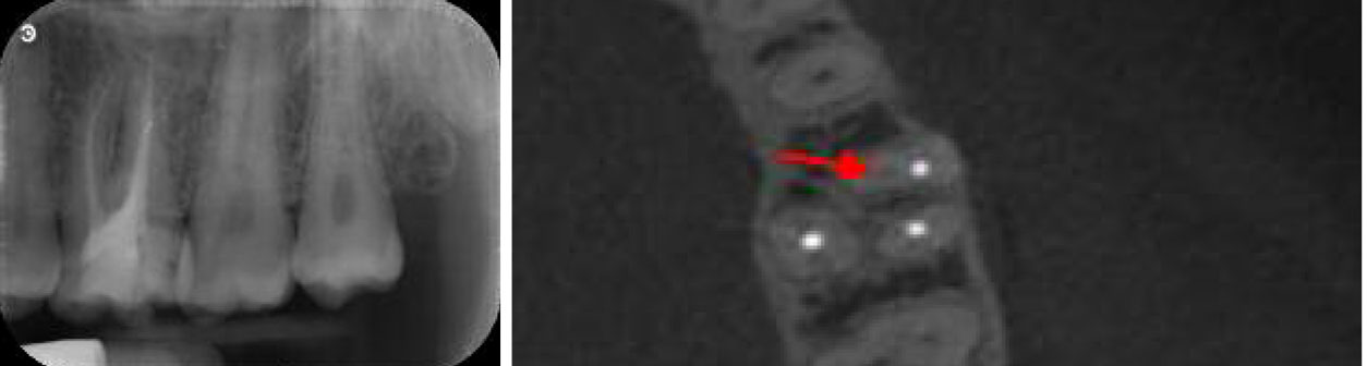 traitement-endodontique-CBCT-realise-en-amont