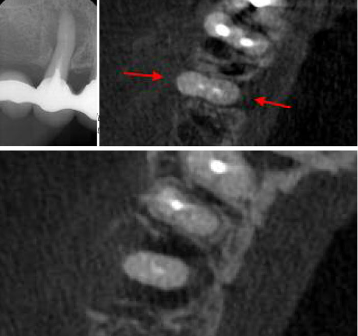 Coupe-axiale-du-CBCT