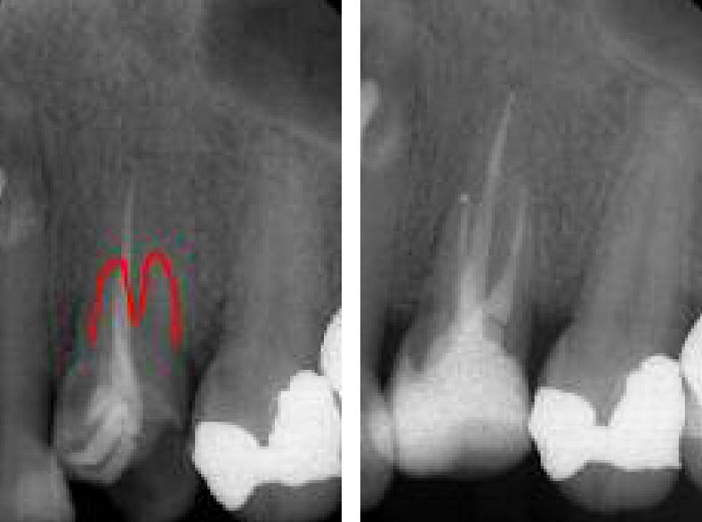 cliche retroalveolaire,