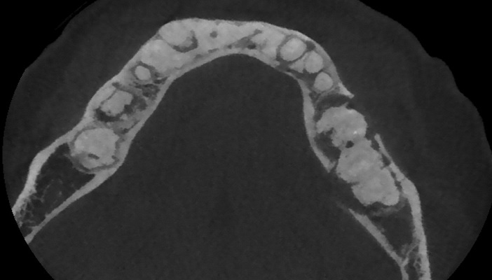 coupe axiale d-un CBCT