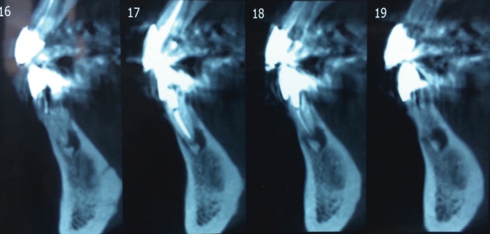 coupes sagittales d-un CBCT