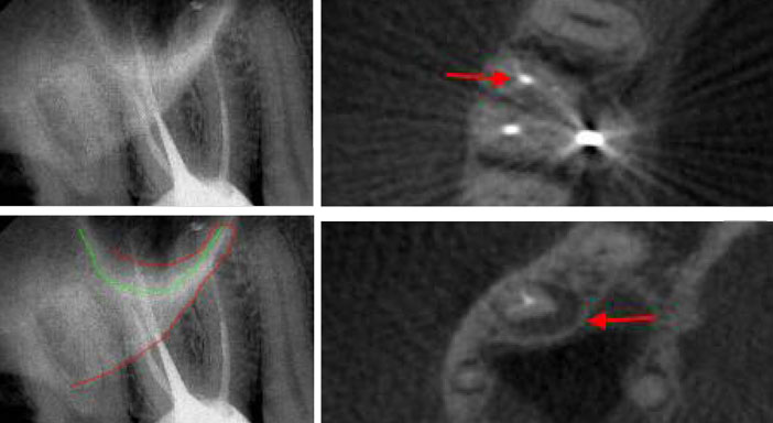 image-radioclaire-periapicale-sur-la-racine-MV