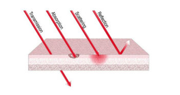 La dépigmentation gingivale par le laser interactions-laser-tissus-vivants