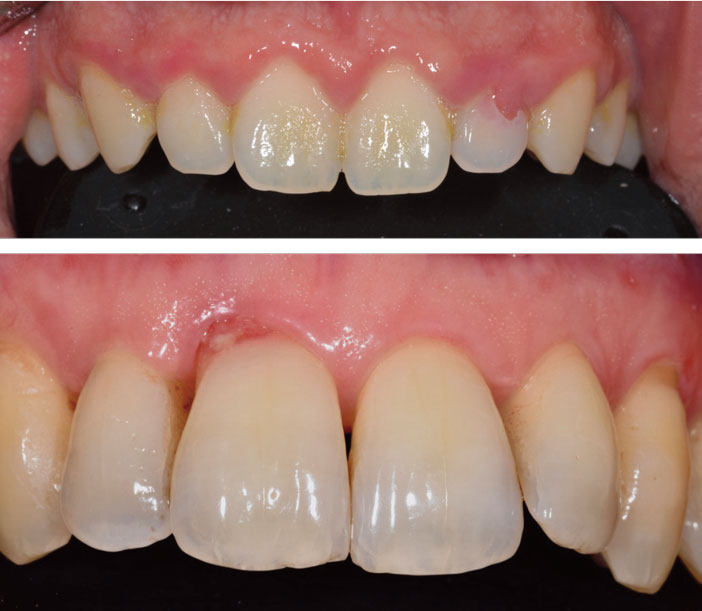 mecanisme-et-particularites-de-ce-type-de-resorption