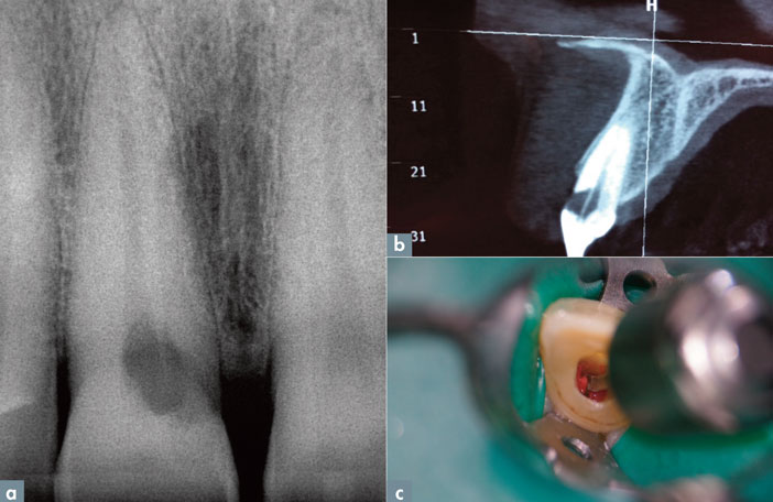 radiographie-retro-alveolaire