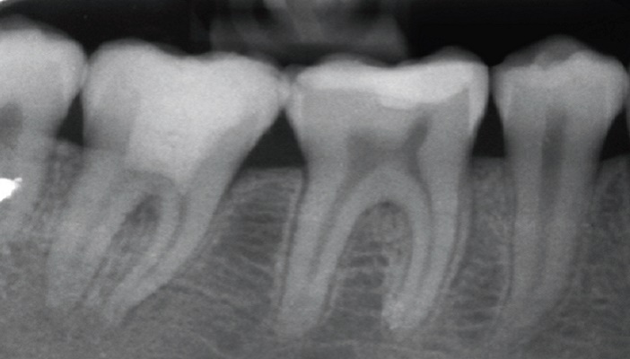 traitement endodontique partiel