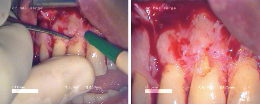 curetage-du-tissu-de-granulation