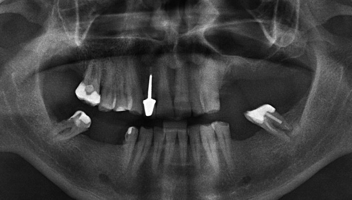 radiographie apres la realisation