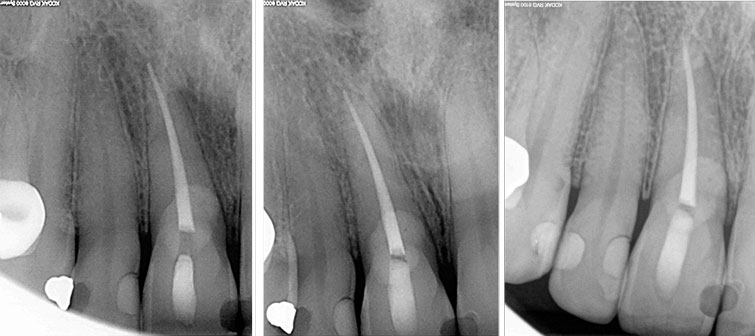 recidive-de-la-resorption-externes