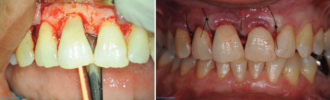 sutures-fil-non-resorbable