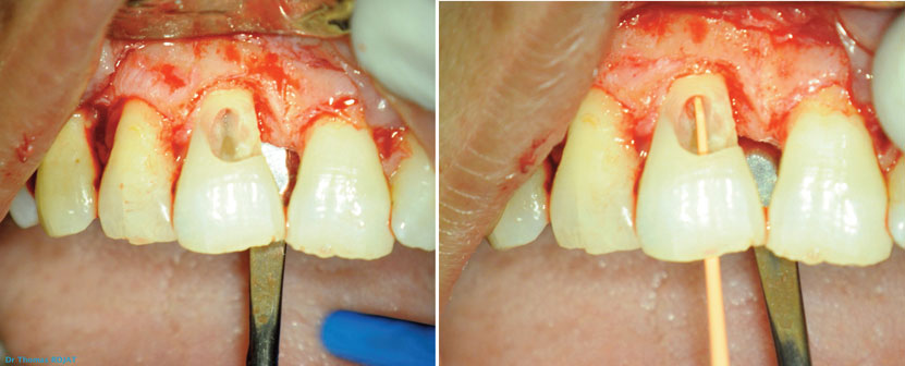 visualisation-de-la-lesion