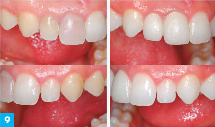 Bloc-incisivo-canin-maxillaire-ecarteur