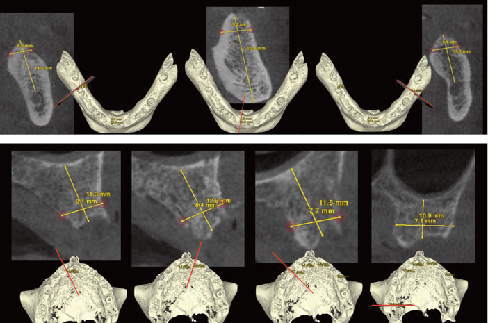 CBCT-de-l-arcade-inferieure