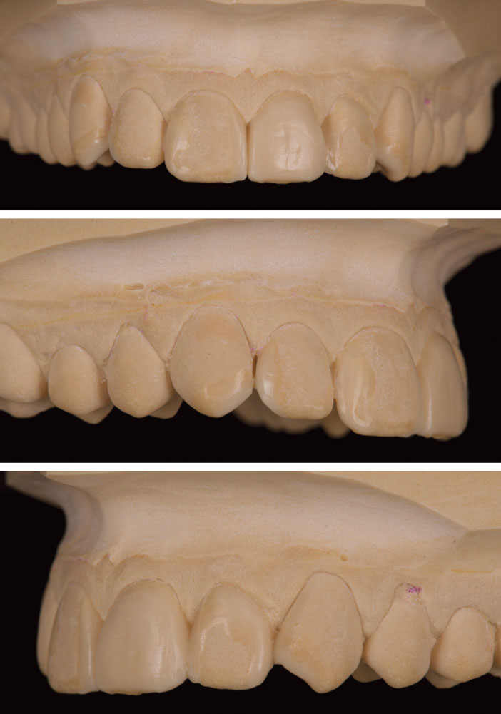 Cire-de-diagnostique-wax-up