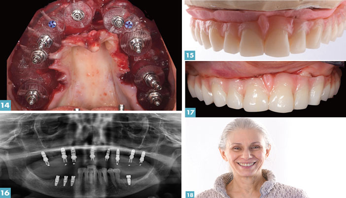 Travail-chirurgical-et-prothetique