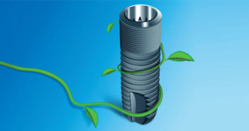 Tva et implants dentaires : chirurgiens-dentistes, ne tremblez plus ! Tva-et-implants-dentaires