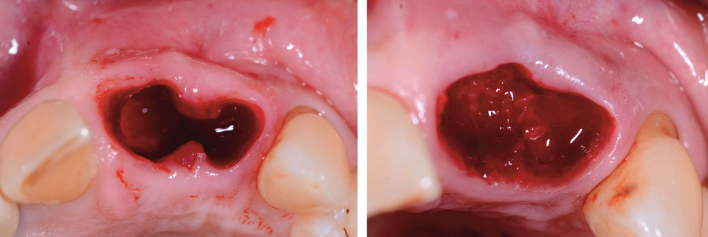 extraction-des-deux-incisives