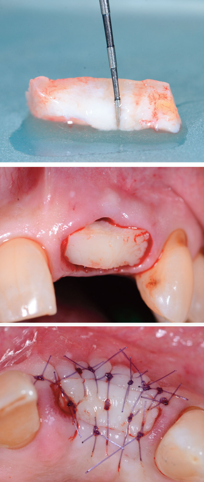 L'extraction dentaire – préservation osseuse avant la mise en place d'un  implant dentaire Le Perreux sur Marne (94170)