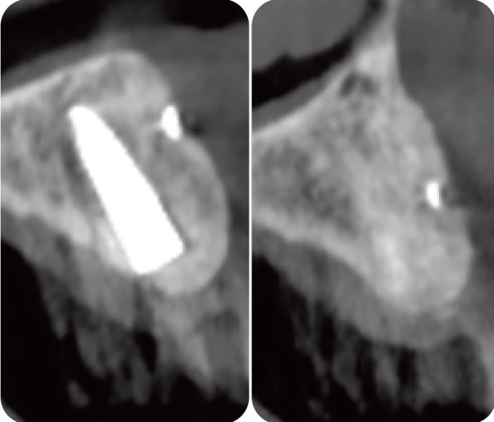 jonction-muco-gingivale