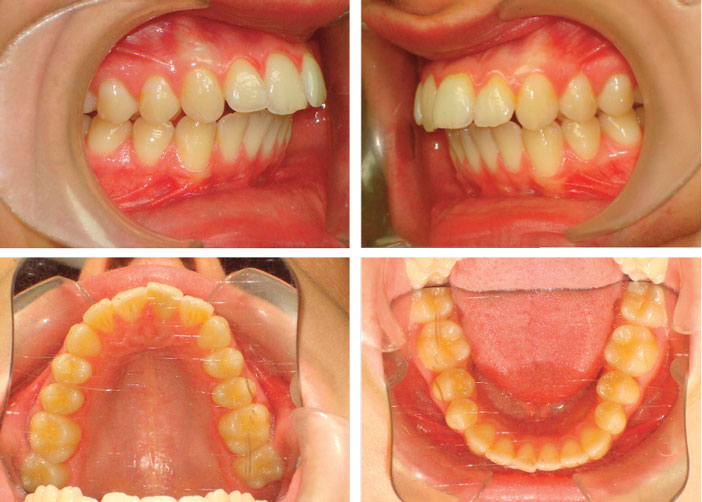 malocclusion-de-classe-2