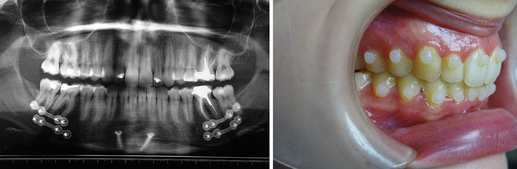 osteotomie-d-avancee-mandibulaire