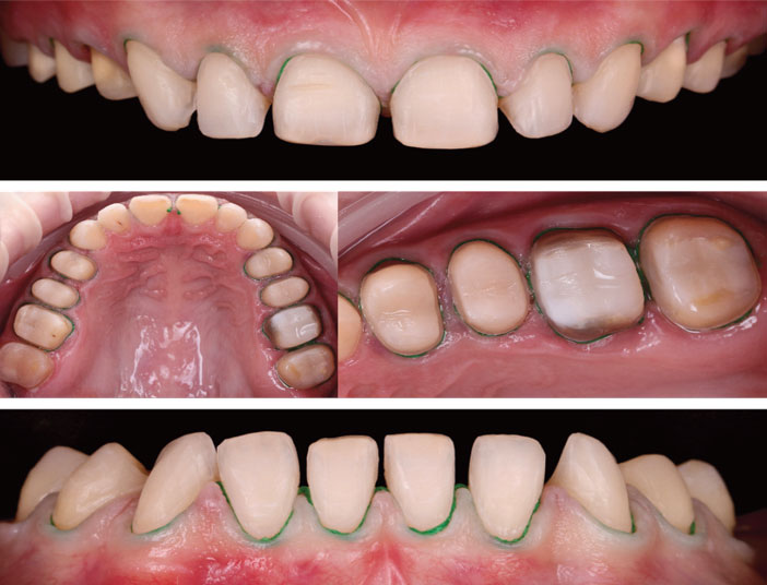 preparation-micro-invasive-terminee