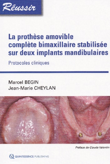 prothese-amovible-complete-bimaxillaire-stabilisee