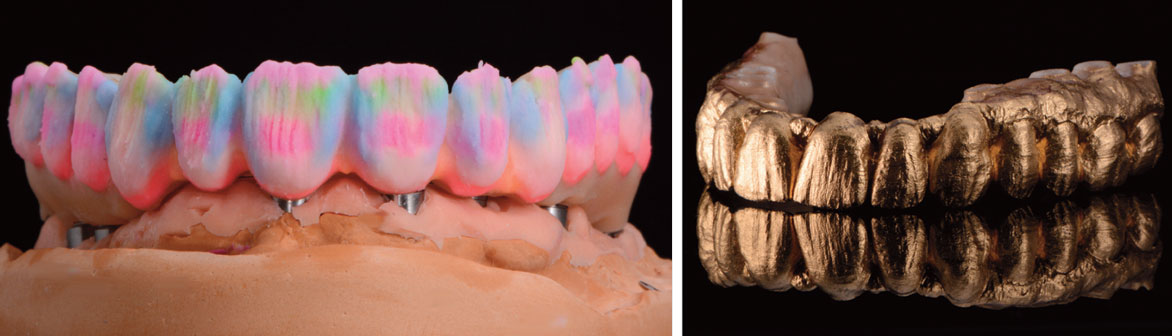 stratification-des-faces-vestibulaires