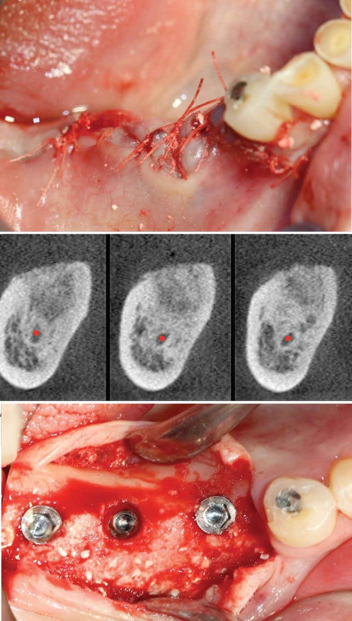 sutures-du-lambeau-en-tension