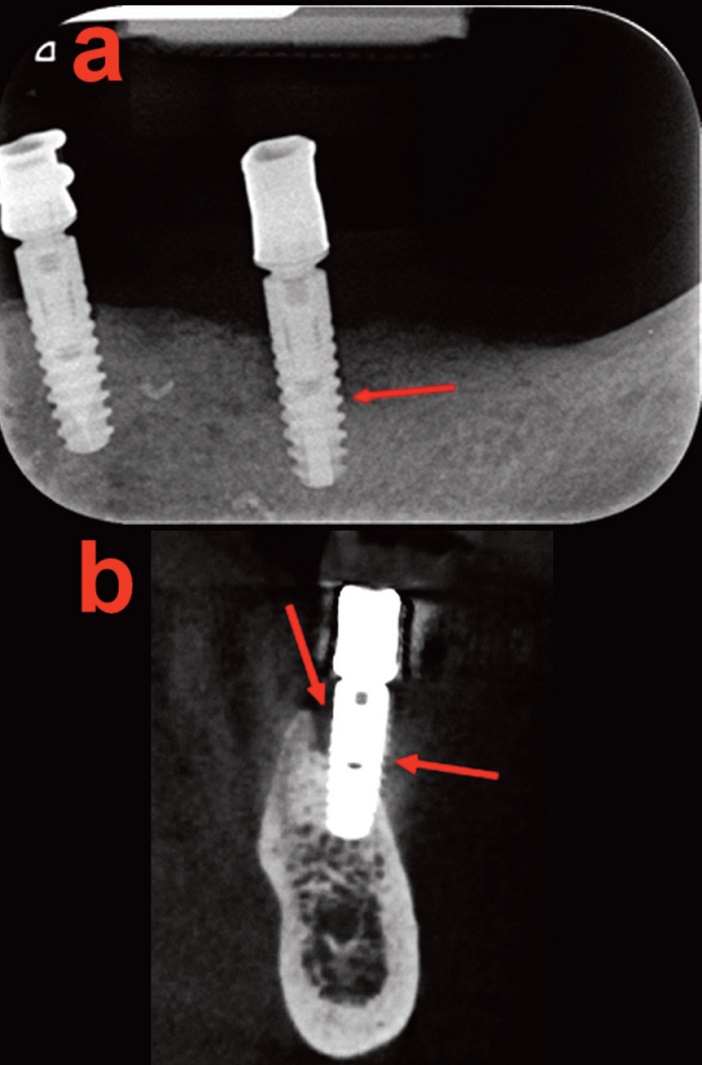 Douleur a l-aplomb de l-implant distal