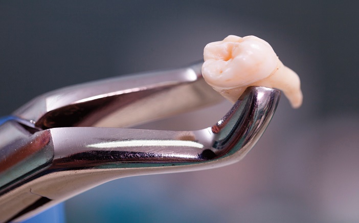 Extractions de dents definitives retenues