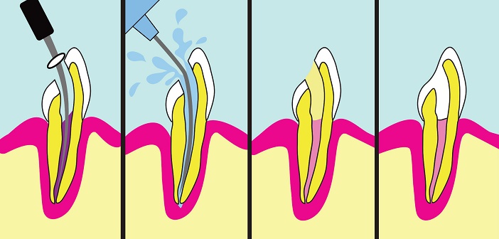 Les dents definitives