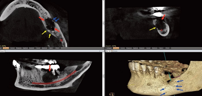 carcinome epidermoide gingival