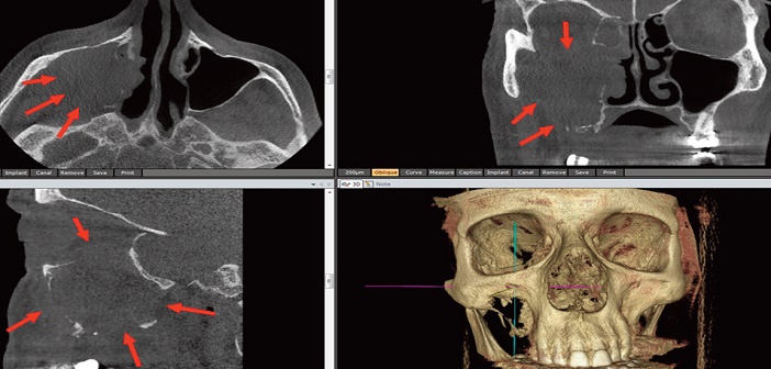 carcinome epidermoide