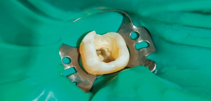 endodontie sur dent definitive non vivante