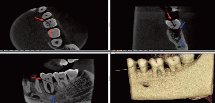 fracture et alveolyse inter-radiculaire