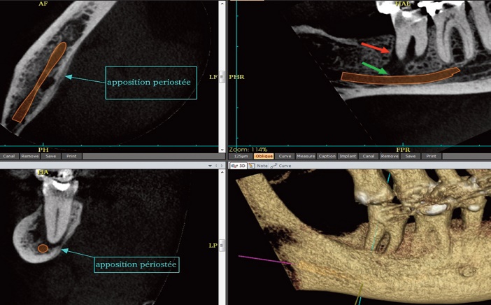 lesion endoparodontale