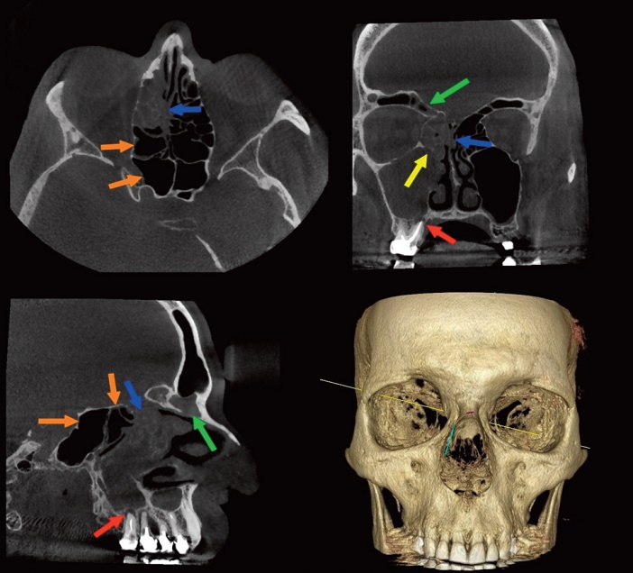 sinusite odontogene anterieure