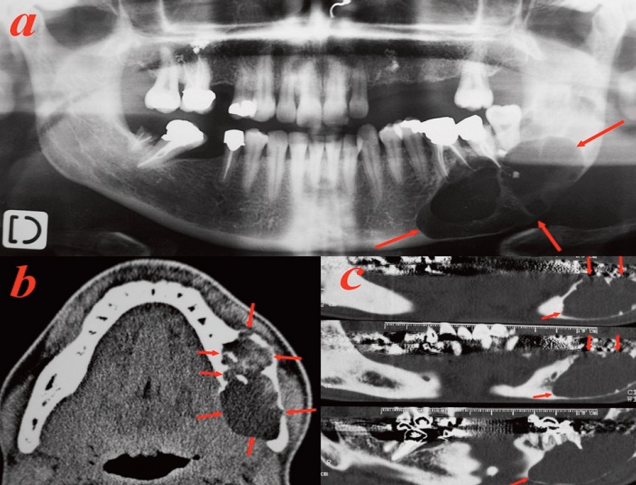 tumeur multikystique mandibulaire posterieure gauche