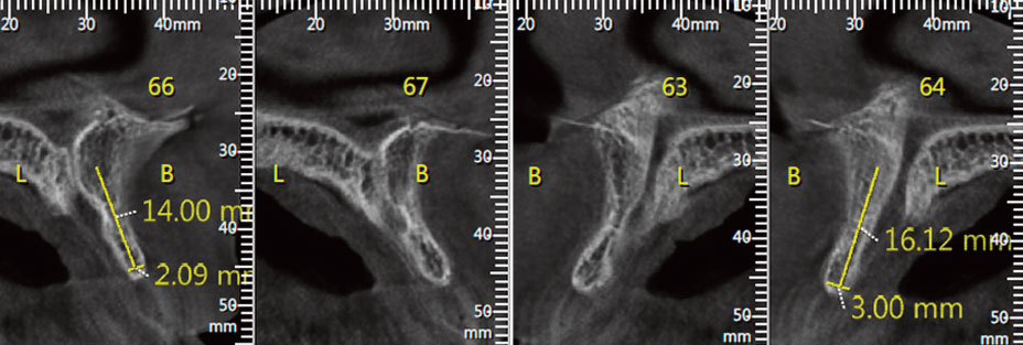 CBCT-montrant-la-finesse-de-la-crete