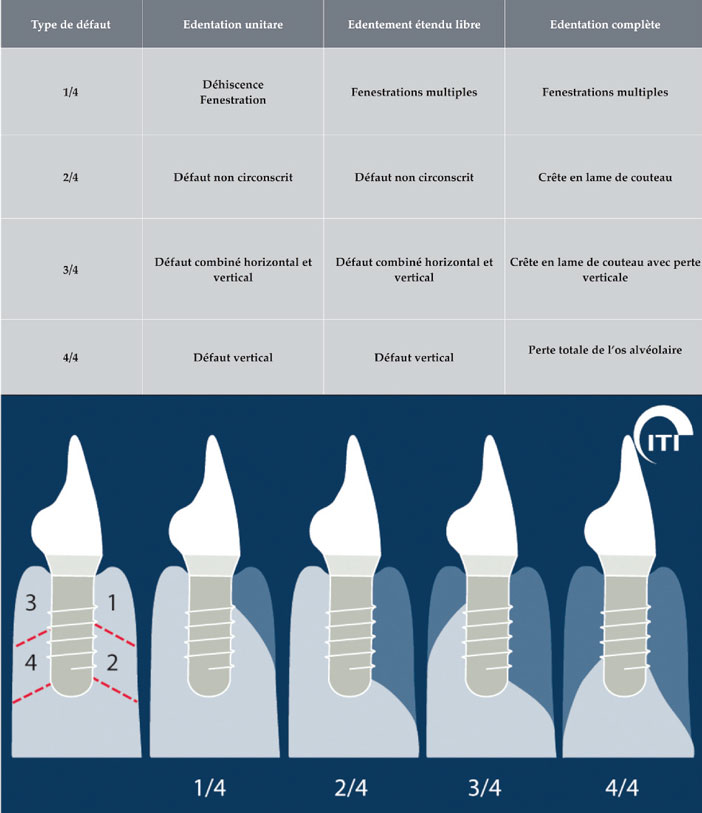 classification-de-resorption-osseuse