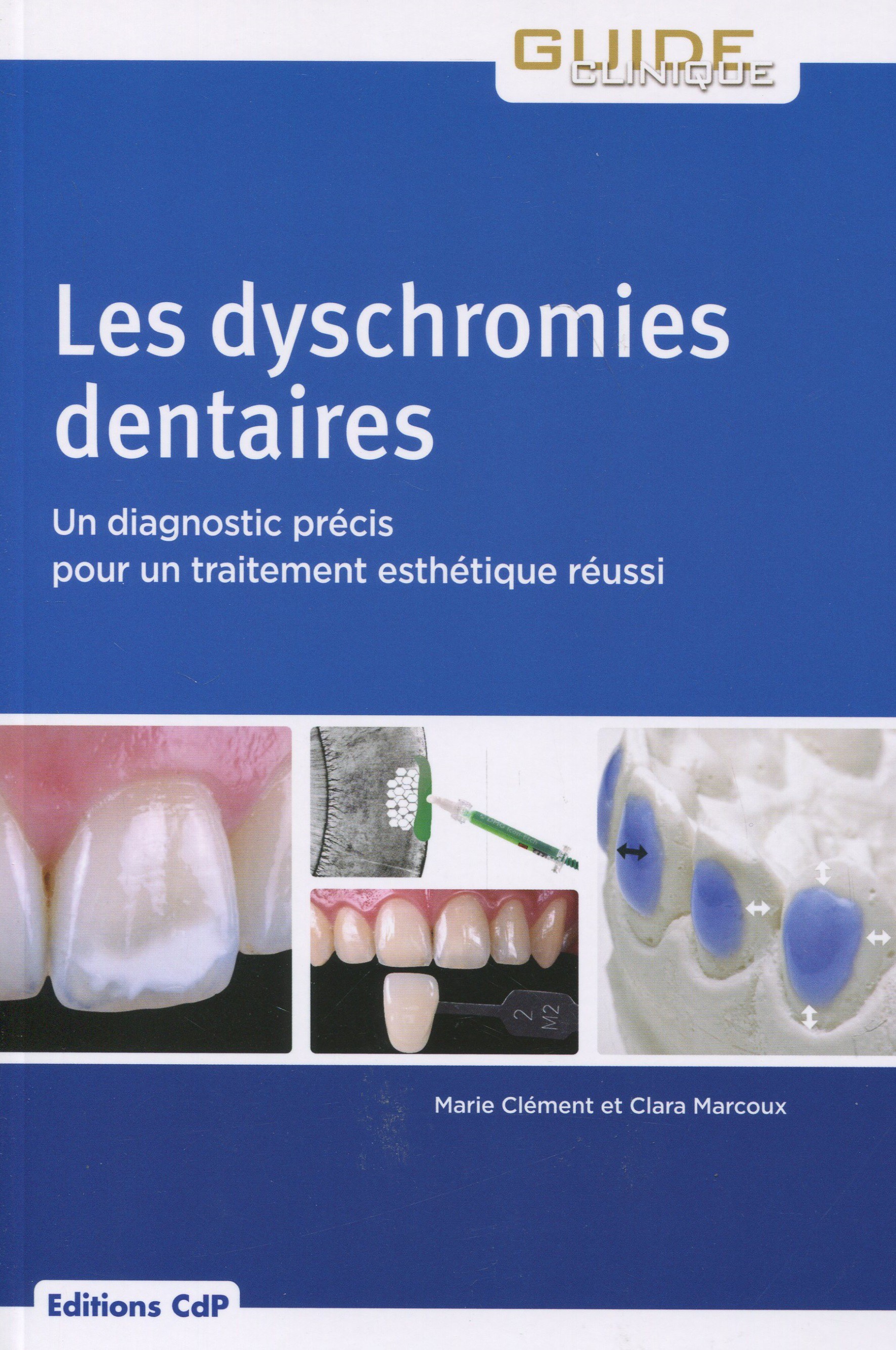 dyschromies dentaires