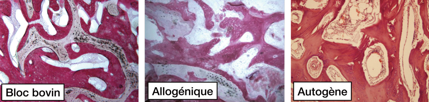 histologie-apres-greffe-avec-bloc-osseux