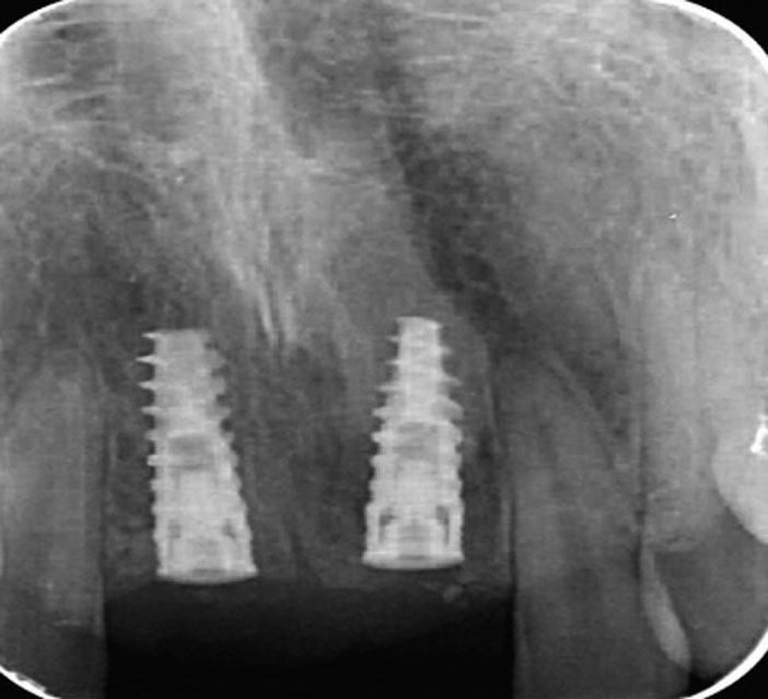 radio-periapicale-implants-en-place