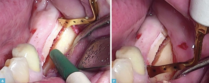 traits-d-osteotomie-en-mesial